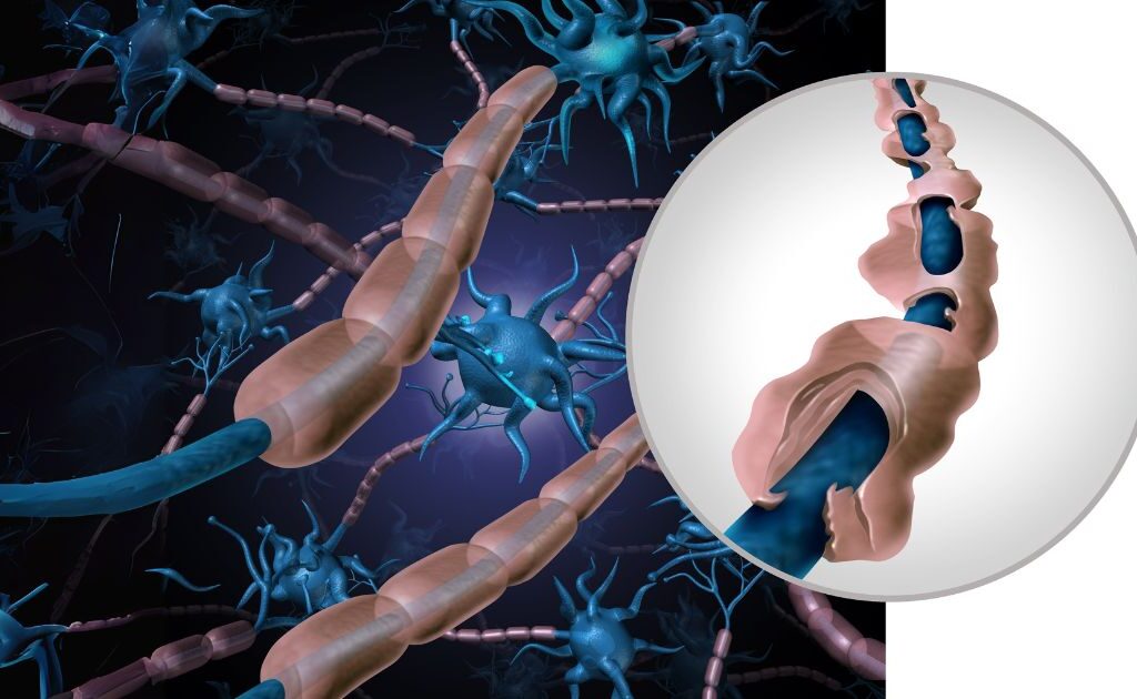 Multiple sclerosis - טרשת נפוצה