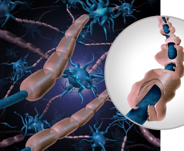 Multiple sclerosis - טרשת נפוצה