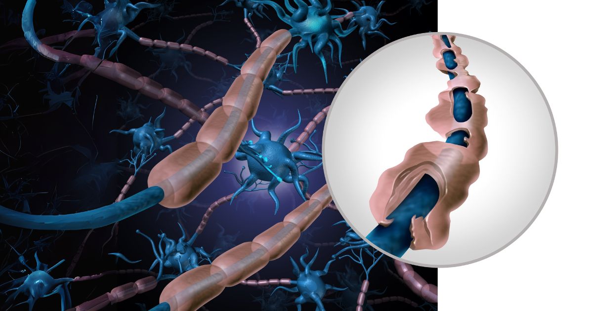 Multiple sclerosis - טרשת נפוצה