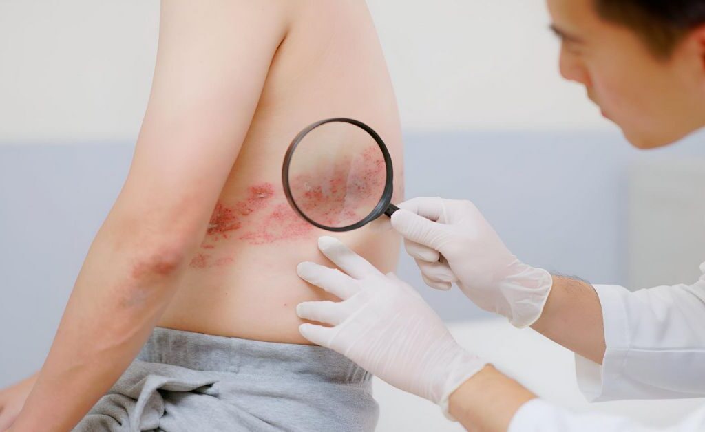 כך מתעוררת שלבקת חוגרת