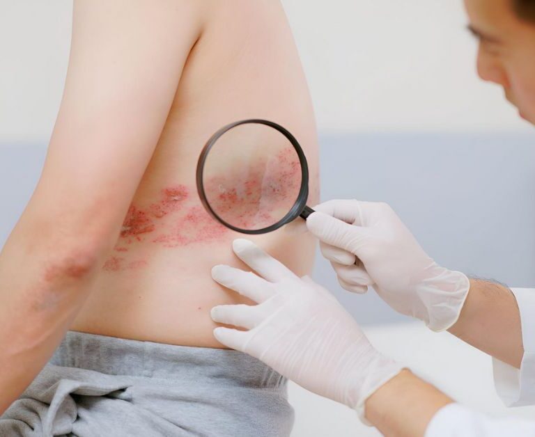 כך מתעוררת שלבקת חוגרת