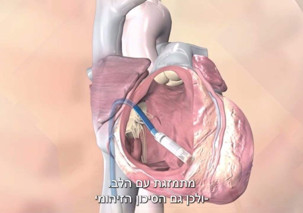 קוצב הלב הזעיר בעולם לטיפול בבעיות בקצב לב | medically