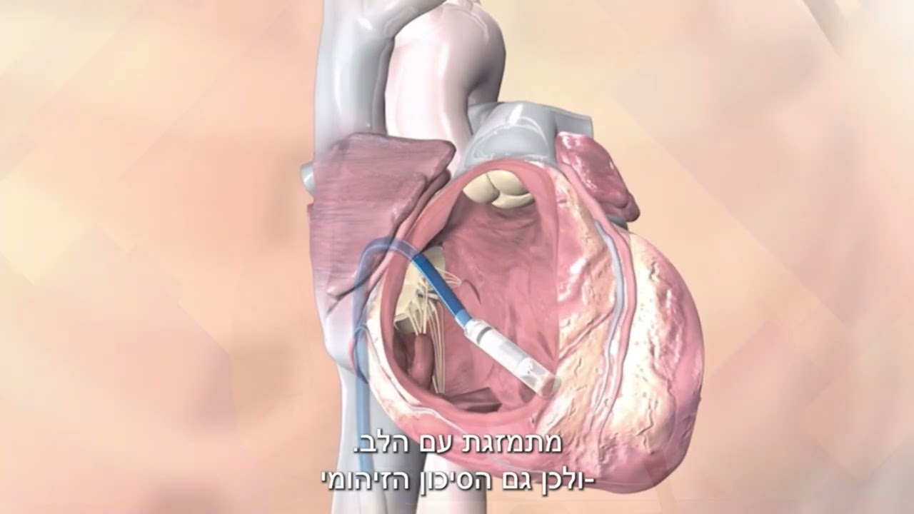 קוצב הלב הזעיר בעולם לטיפול בבעיות בקצב לב | medically